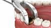 Dental Extraction Simple 140 Intermediate 195 Advanced 295